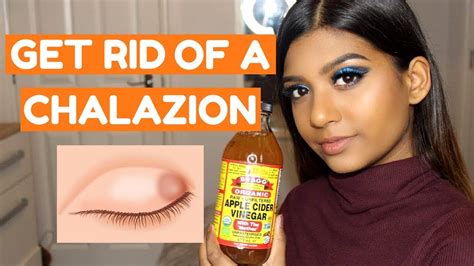 apple cider for chalazion|chalazion treatment at home.